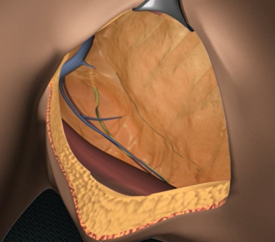 Λεμφαδενικός Καθαρισμός Μασχάλης