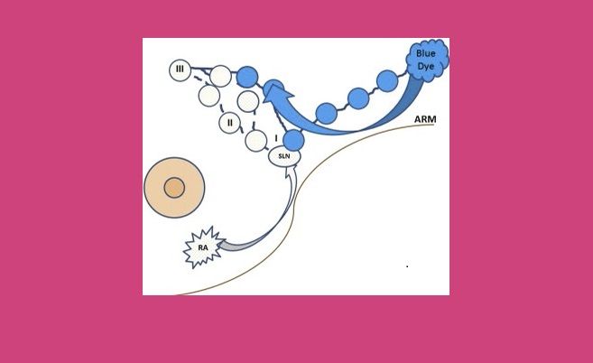 Ανάστροφη Χαρτογράφηση Μασχαλιαίων Λεμφαδένων