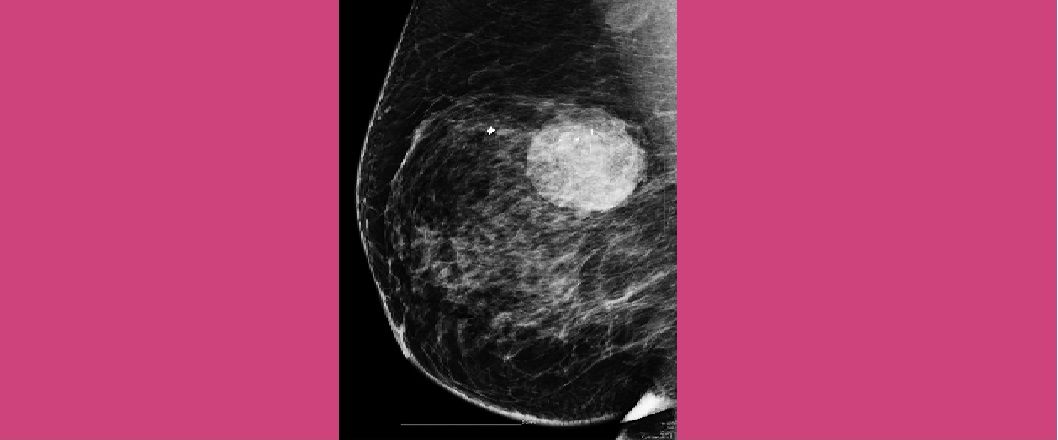 Φυλλοειδής Όγκος Μαστού